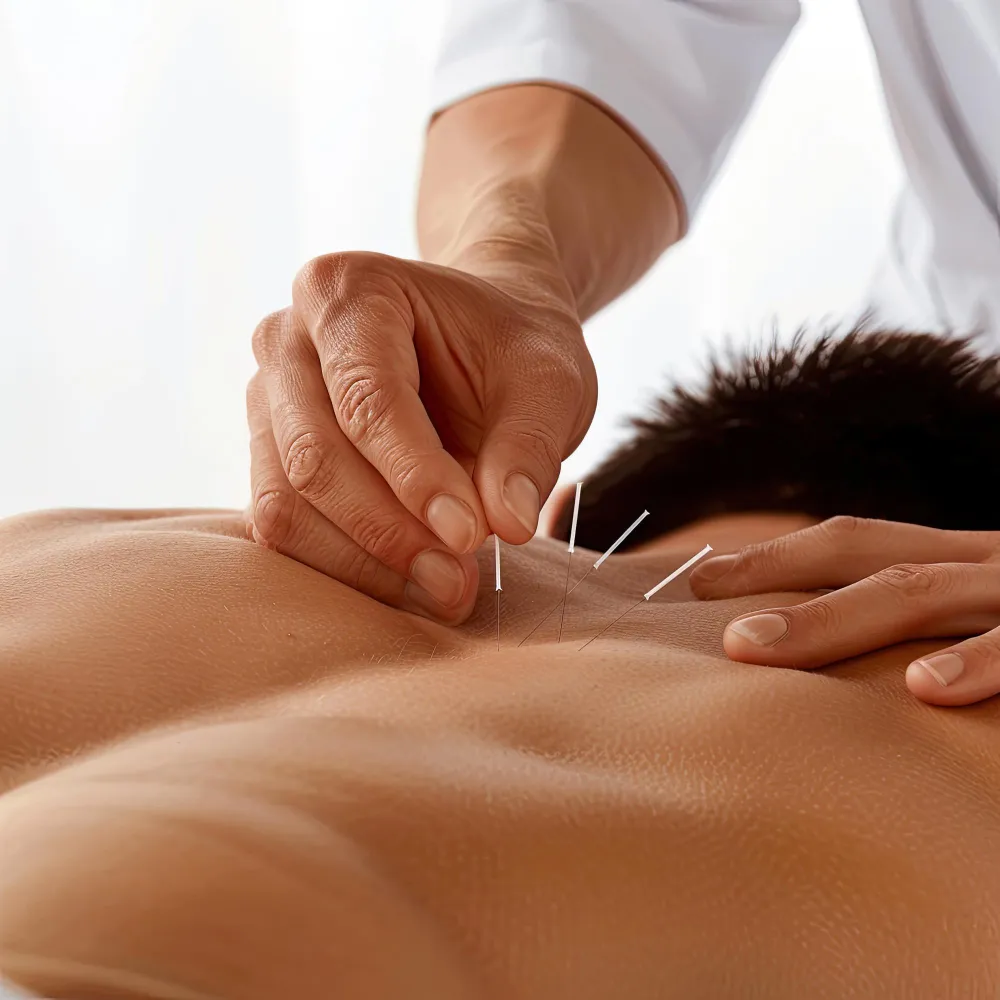 CARE Physiotherapy Dry Needling Calgary